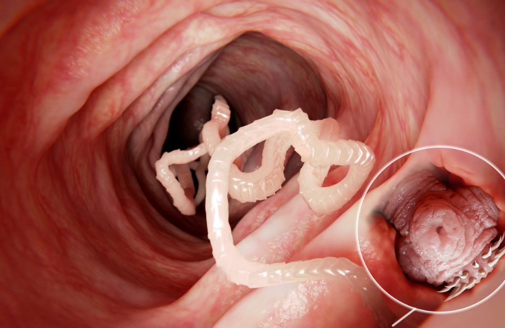 Tapeworms Infection